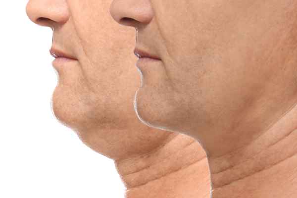 HIFU - Breakthrough in Anti - ageing 2 hifu results Wisley
