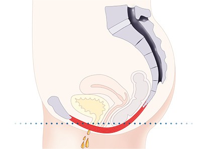 Pelvic-Floor Muscle Repair 5 Pelvic floor muscles Wisley