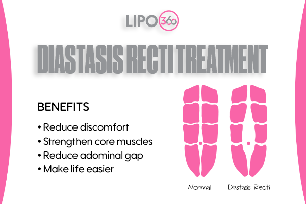 diastasis recti treatment Wisley