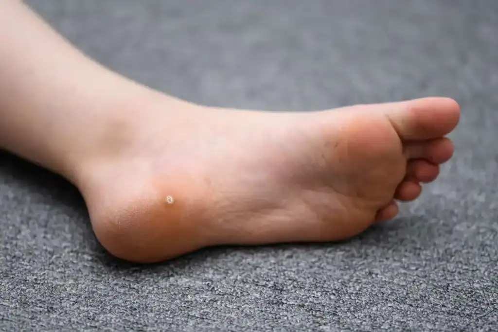 Cryotherapy For Warts And Also Verrucas 2 Image of verruca on the bottom of the foot that able to be treated with Cryotherapy Wisley