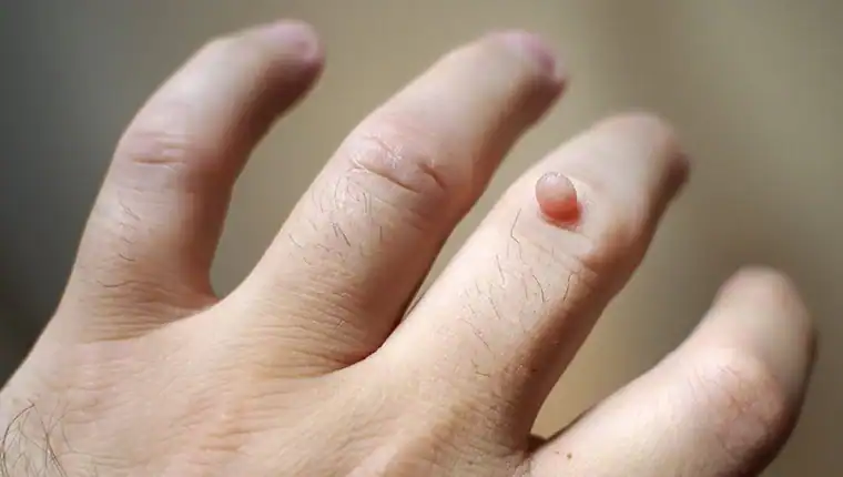 Image of blemish that Cryotherapy Wisley can remove with Lipo 360.