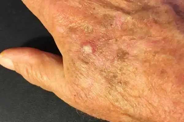 Image of Actinic keratoses Wisley on a person hand