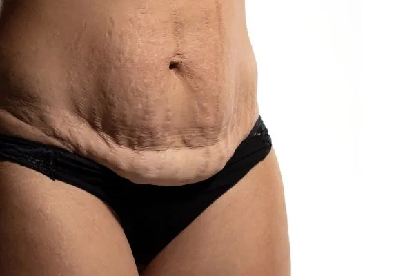 The science behind skin tightening Wisley picture of a woman's sagging skin on the stomach